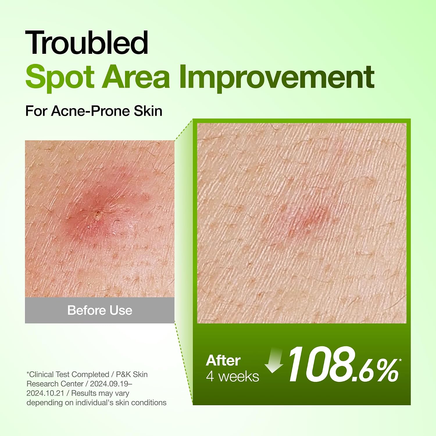 Anua Azelaic Hyaluron Soothing Serum 30ml For Redness Relief, Hydration & Skin Brightening