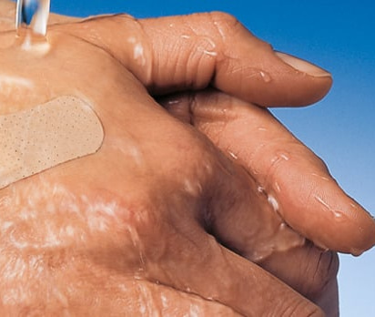 Dermaplast Soft Injection Needles 16mm X 40mm Pack Of 250