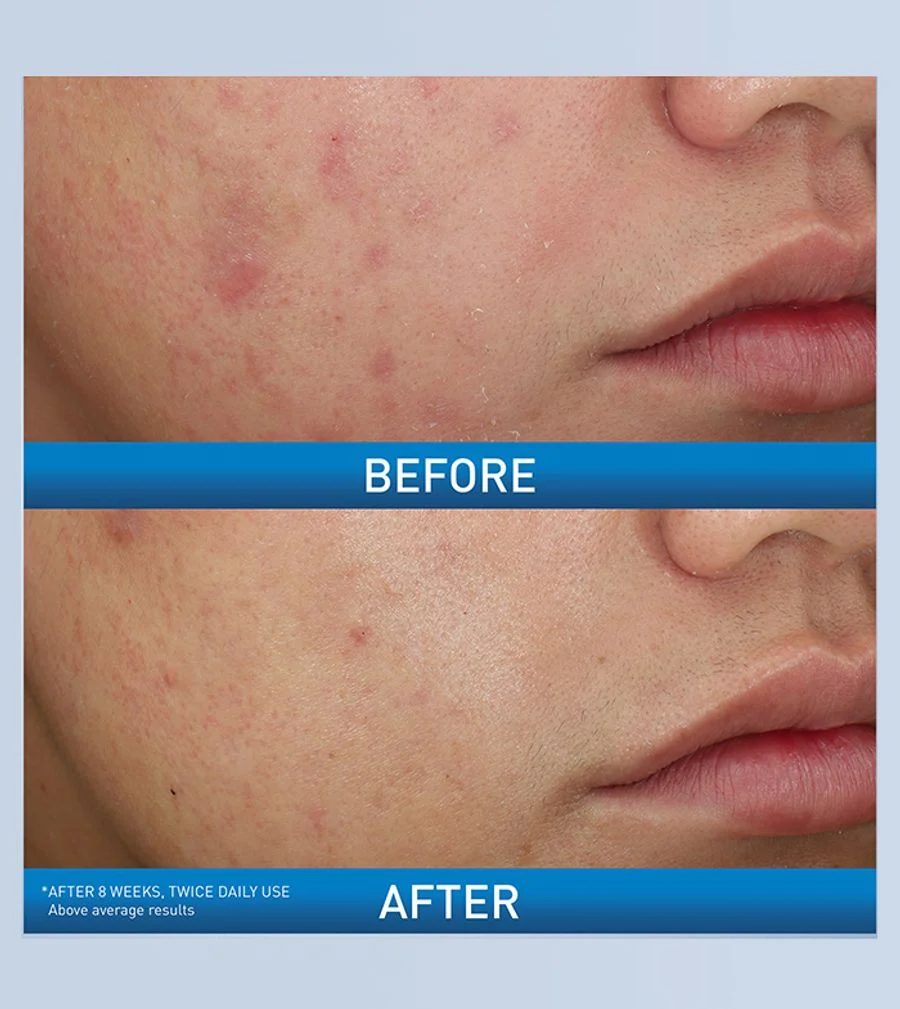 Cerave Acne Foaming Cream Wash 10% Benzoyl Peroxide 150ml – Maximum Strength Acne Treatment
