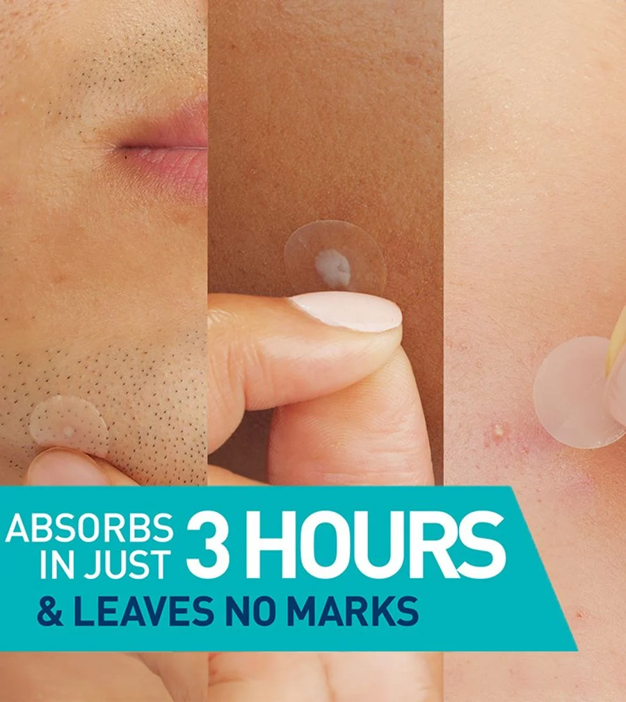 Cerave Blemish Barrier Patches 22's For Acne Pimples, Spot Protection & Faster Healing