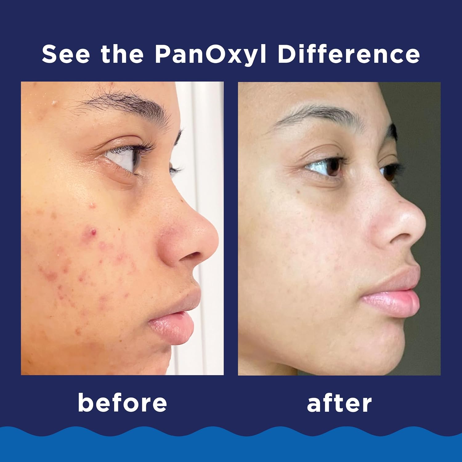 Panoxyl Acne Foaming Wash 10% Benzoyl Peroxide 156g – Clears Acne & Helps Prevent Breakouts