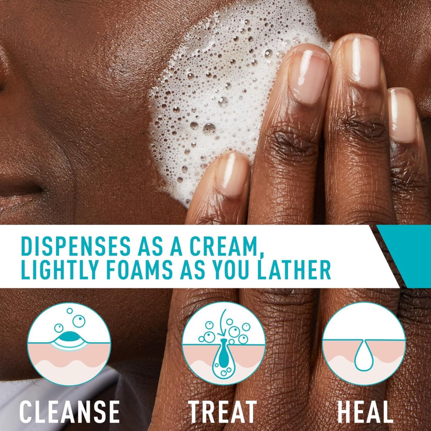 Cerave Acne Foaming Cream Cleanser 4% Benzoyl Peroxide 150ml – Helps Clear Acne & Prevent Breakouts