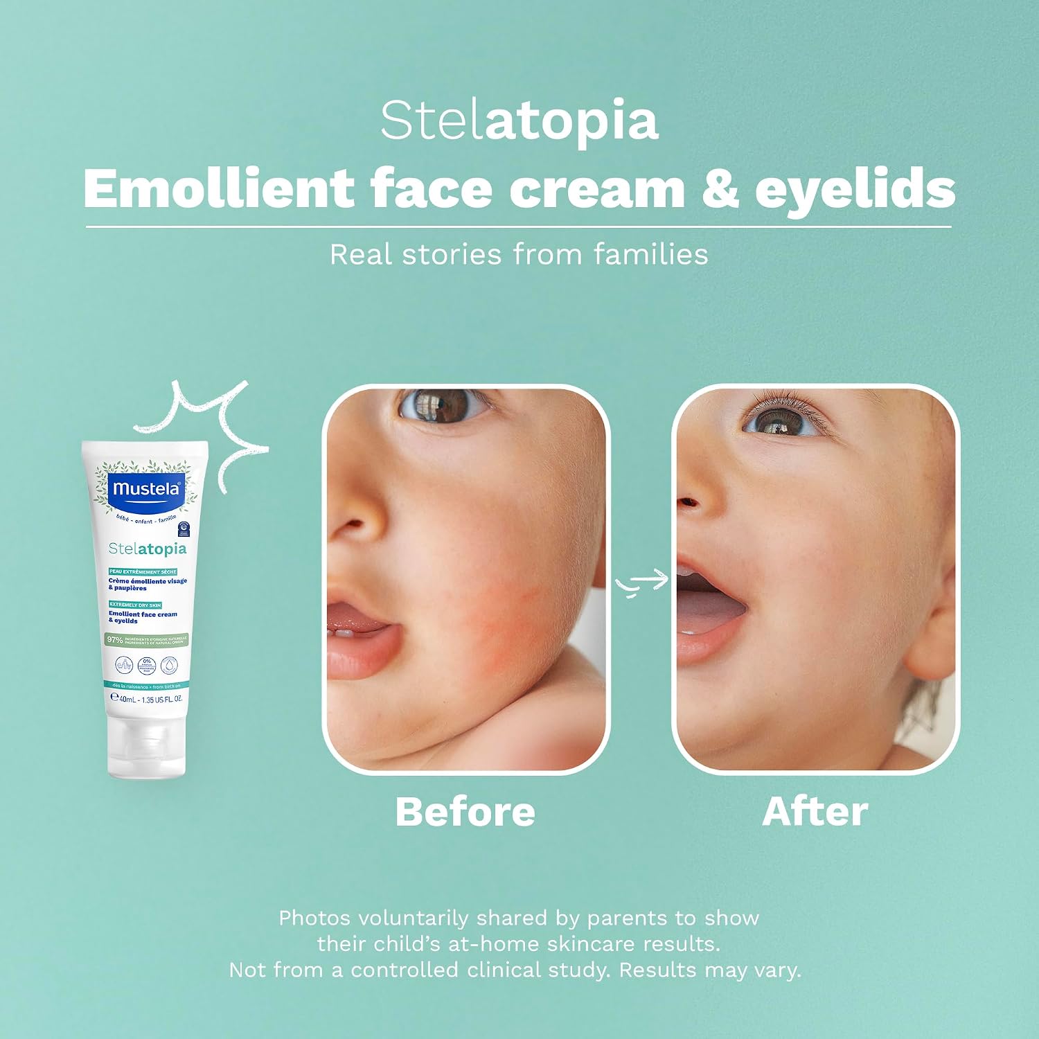 Mustela Stelatopia Emollient Face Cream 40Ml – Soothes & Moisturizes Very Dry Atopic-prone Skin